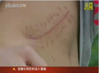 17歲高中生為買iPad2 2萬(wàn)元賣掉自己右腎